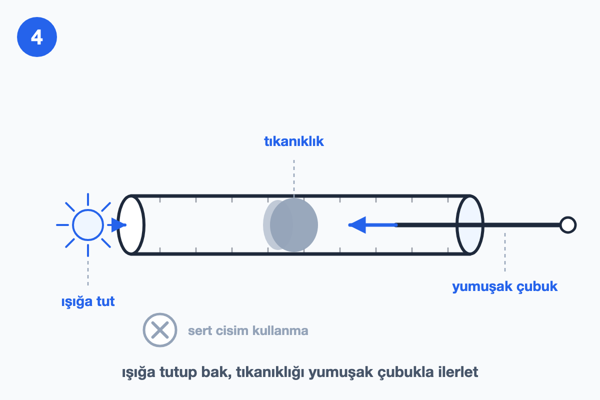 Çıkarılan hortumun ışığa tutulup içindeki tıkanıklığın görülüşünü gösteren çizim